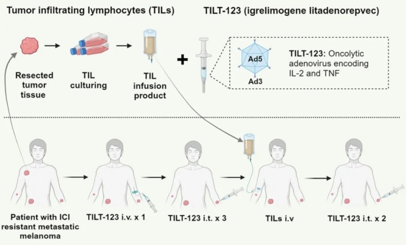 TIL细胞疗联合溶瘤病毒治疗流程