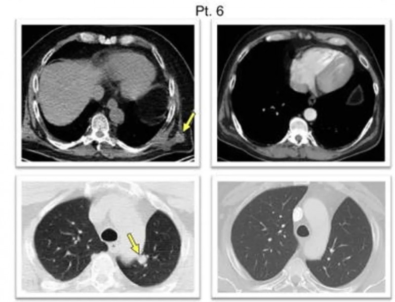 个体化新抗原疫苗治疗黑色素瘤的案例