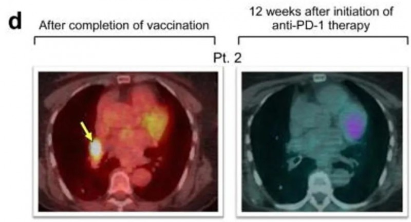 个体化新抗原疫苗治疗黑色素瘤的效果
