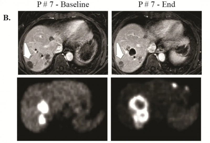 CAR-T HAI疗法治疗干部病灶的效果