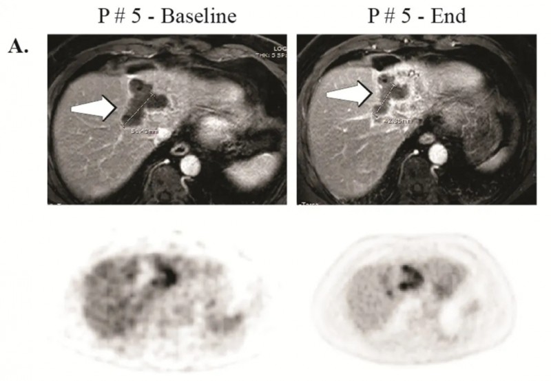CAR-T HAI疗法治疗肝部病灶的效果