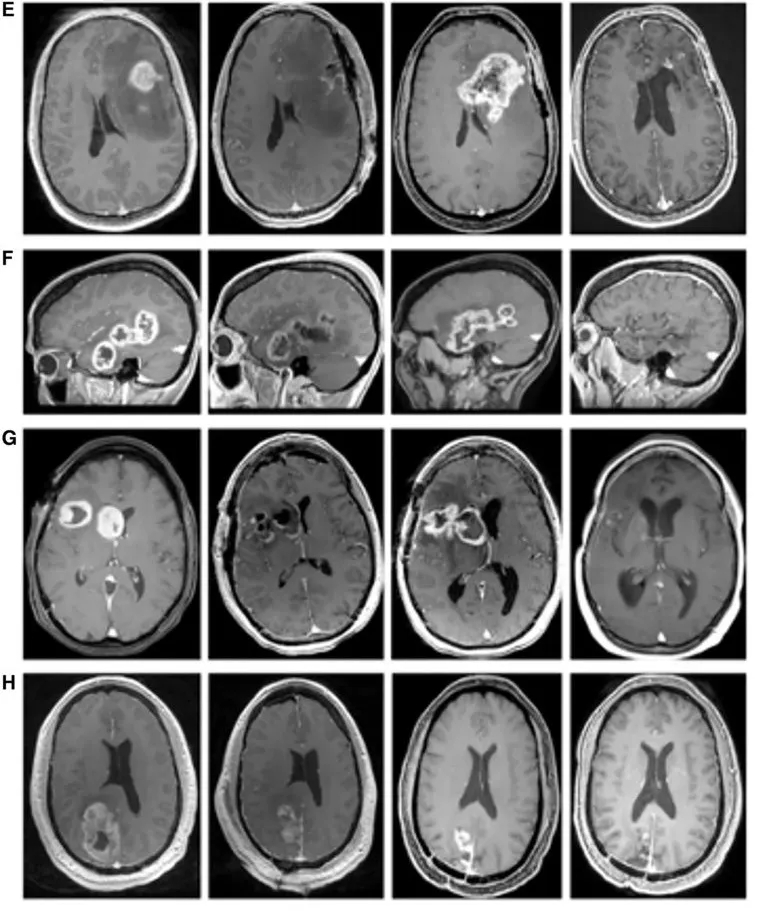 IGV-001治疗胶质母细胞瘤次全切术后的效果