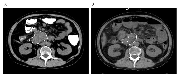 DC疫苗治疗小肠癌的效果