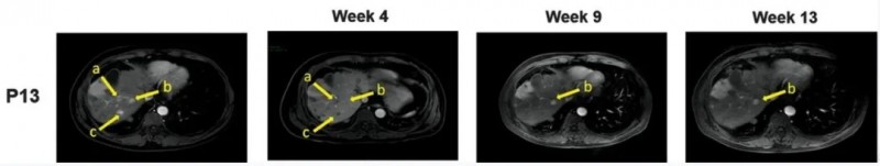 GPC3 CART细胞疗法治疗肝癌的案例