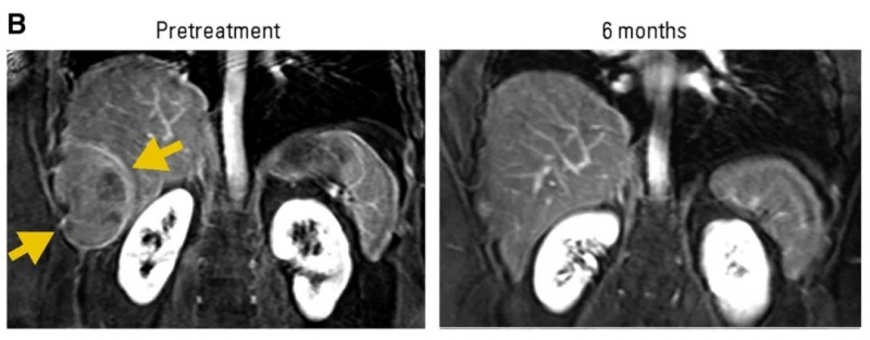 NY-ESO-1 T细胞疗法治疗滑膜肉瘤的效果