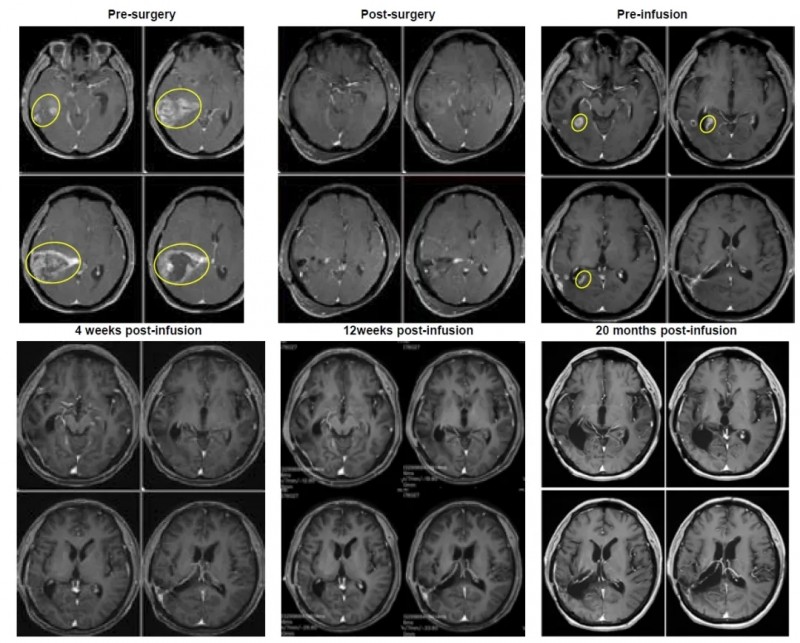 TIL细胞疗法治疗胶质母细胞瘤的效果