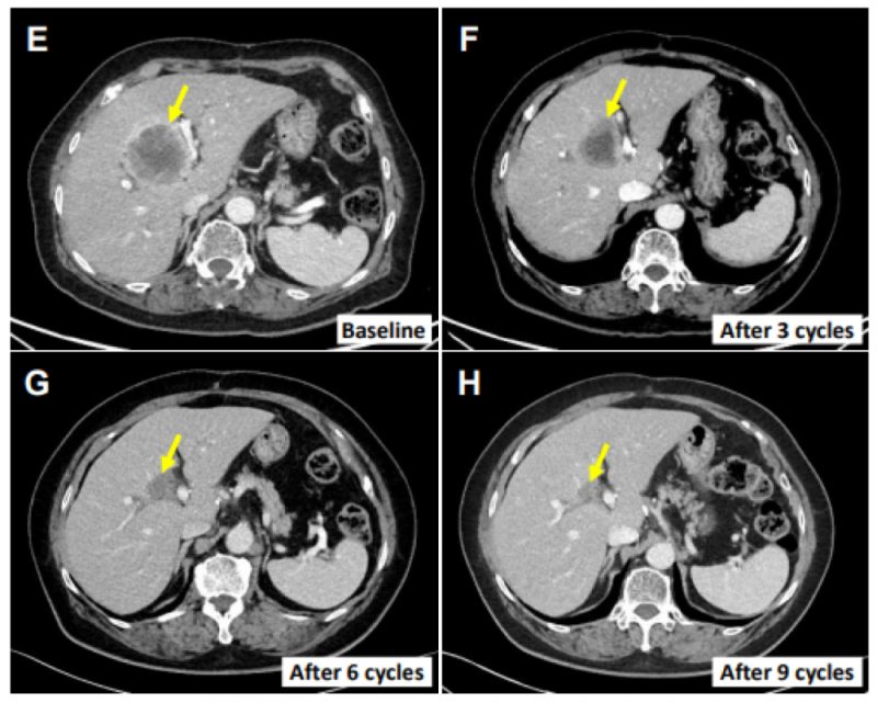 SMT-NK联合帕博利珠单抗治疗肝外胆管癌的效果