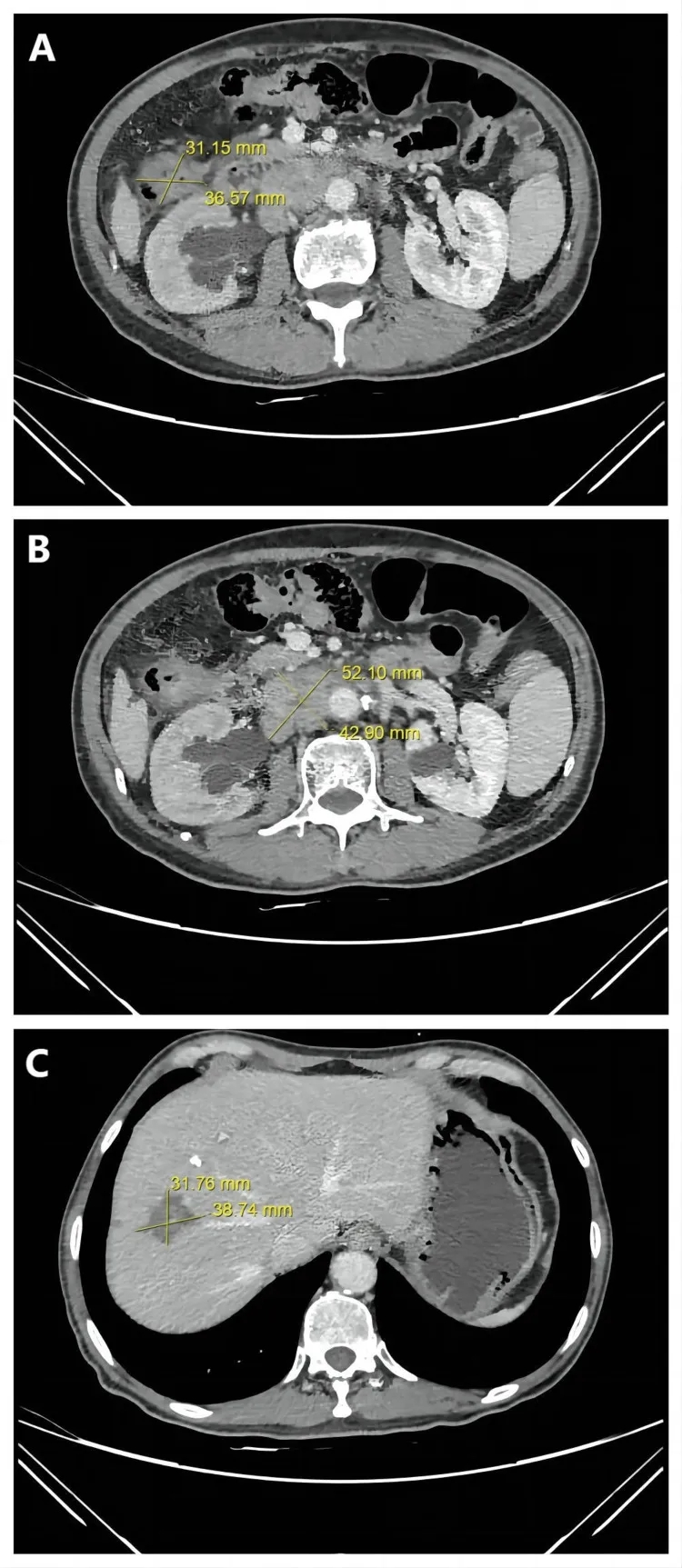 难治的稀有突变型就要用“特效药”！我国自主研发JMT-101再战非小细胞肺癌