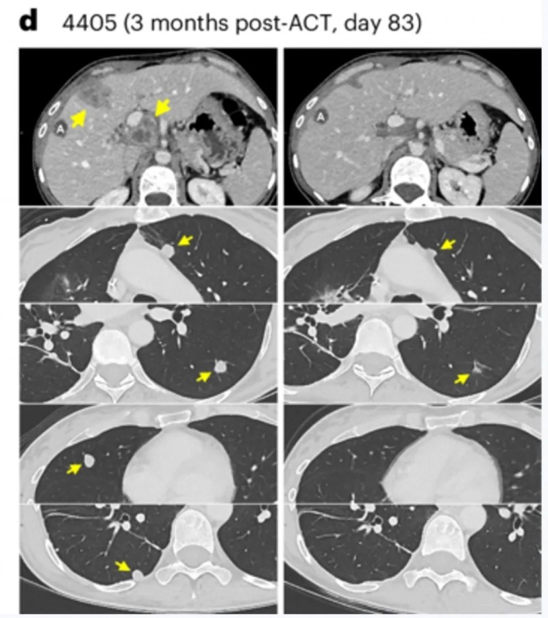 TCR-T疗法交出硬核答卷:多线治疗失败结直肠癌获42.8%客观缓解,多人转移灶消退