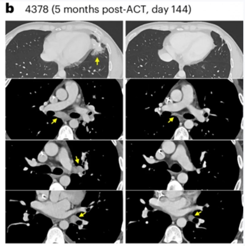 TCR-T细胞疗法治疗转移性直肠癌的效果