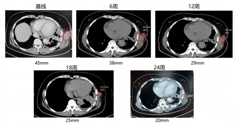 GC101治疗晚期肺腺癌的效果