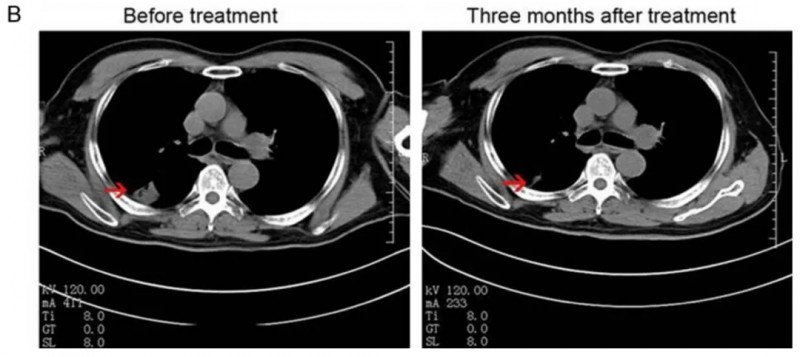 NK细胞疗法联合西妥昔单抗治疗肺癌的效果