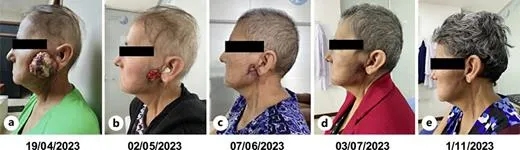 9cm巨大唾液腺肿瘤消失!新型靶向药改写绝境,这些患者可申请免费用药