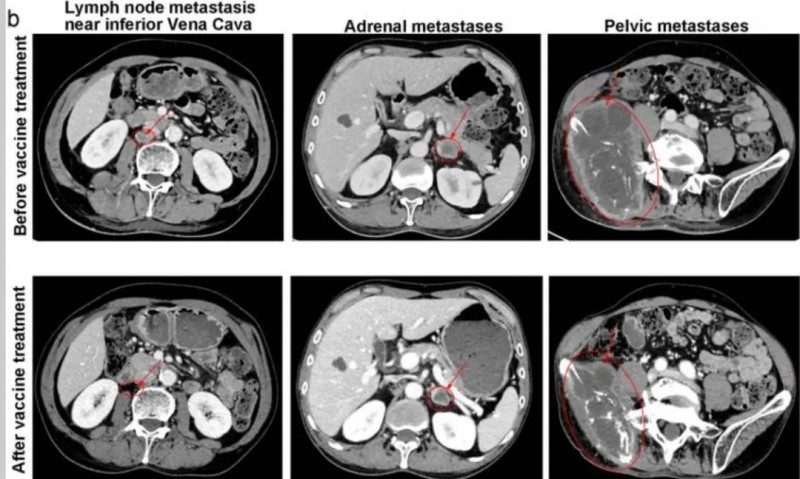 Neo-DCVac治疗肺腺癌的效果