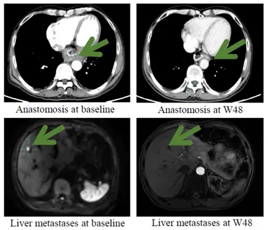 IMC002治疗胃癌的数据