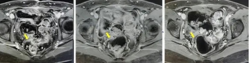 TIL细胞疗法治疗子宫内膜癌的效果
