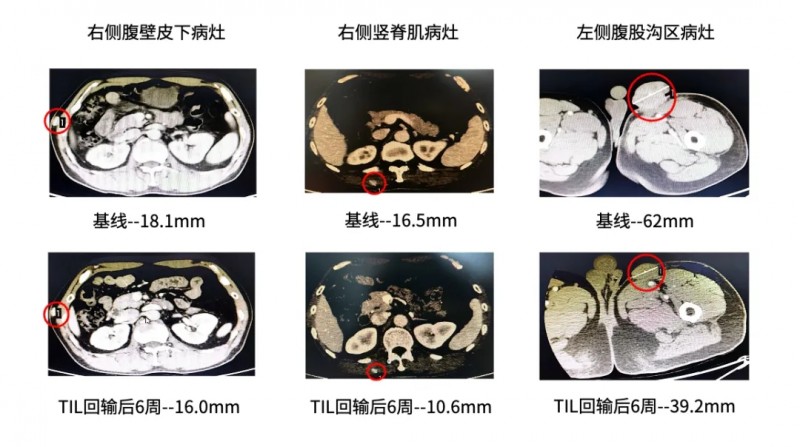 TIL细胞疗法治疗黑色素瘤的效果