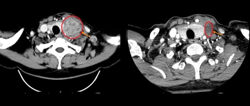 TIL细胞疗法治疗肺癌的效果