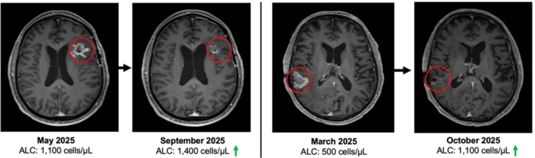 疾病控制率100%!疫苗、CAR-T、NK改写“死亡剧本”!2026脑瘤五大颠覆性疗法盘点