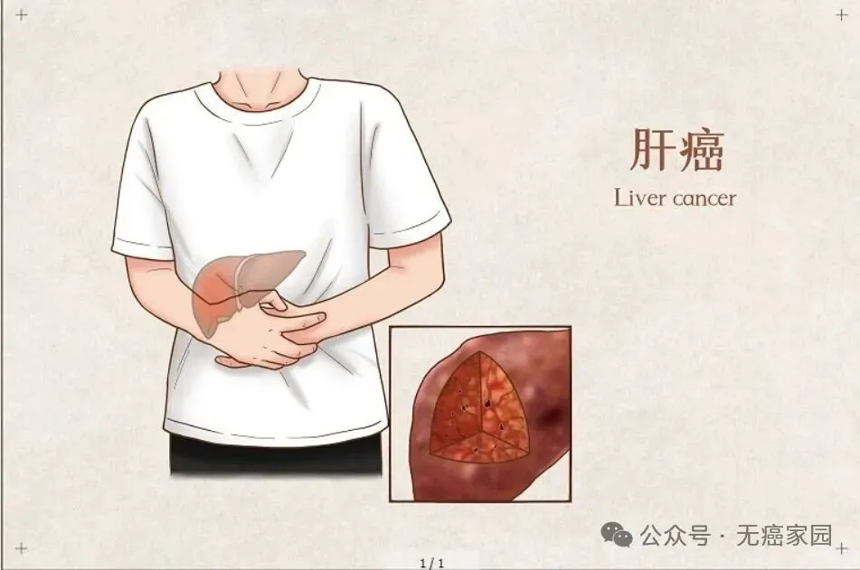 全球首款肝癌TIL疗法：6周肿瘤缩半，18周病灶全消，一位患者的162天逆袭
