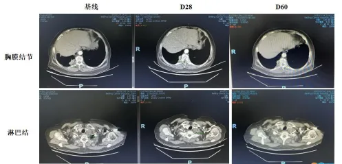 终于有药了!胰腺癌首款泛RAS靶向药获批上市,覆盖90%以上患者!