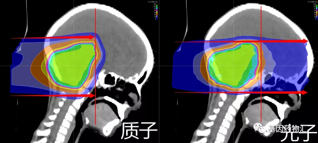 质子治疗和光子放疗照射范围和剂量对比