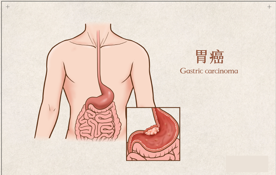无癌生存近4年!新型NK细胞疗法不容小觑,晚期胃癌患者输注至今无复发!