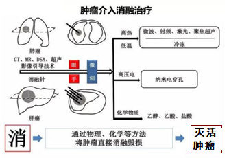 肿瘤消融技术,让肿瘤治疗更安全高效!
