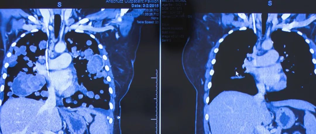 晚期癌症患者也能完全缓解?治疗失败后一定要知道的3大新方案