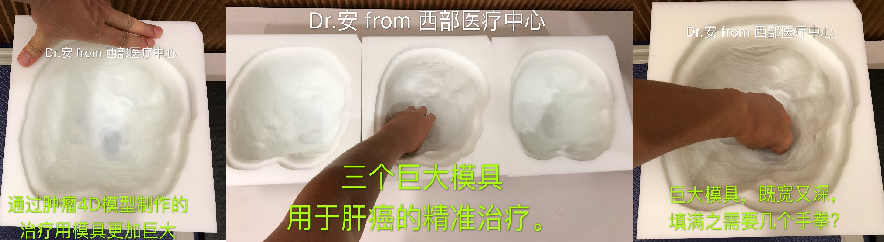 质子治疗模具