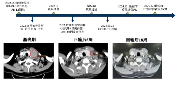 仅12周肿瘤靶病灶完全缓解!全球首款无需清淋自体TIL疗法成为肺癌"救