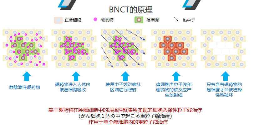日本硼中子俘获疗法(BNCT)，治疗时间30～60分钟，精准“爆破”癌细胞