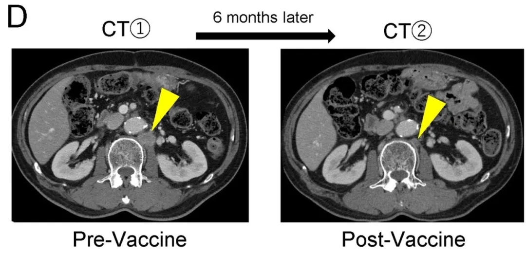 Neo-P DC疫苗治疗胰腺癌的效果