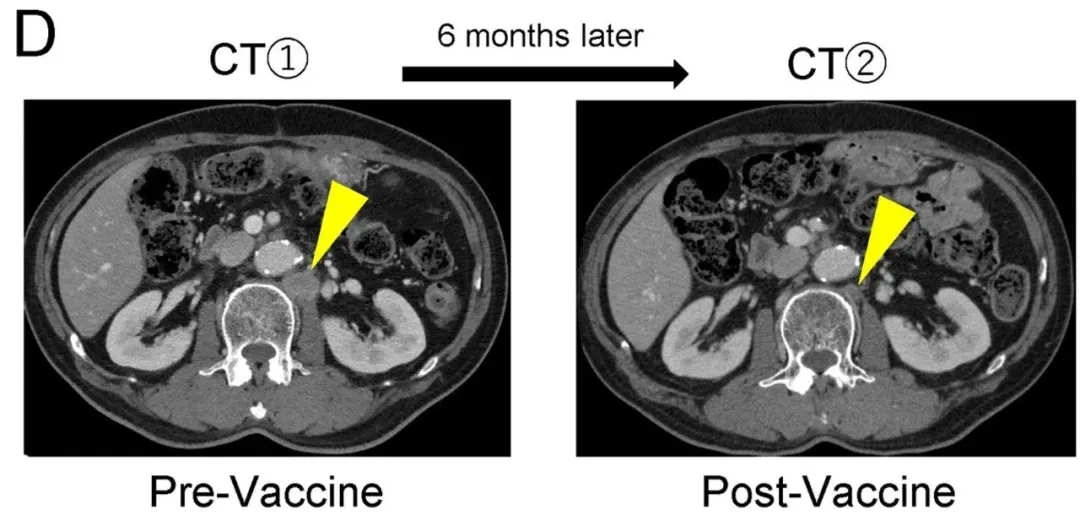 Neo-PDC疫苗治疗胰腺癌的效果