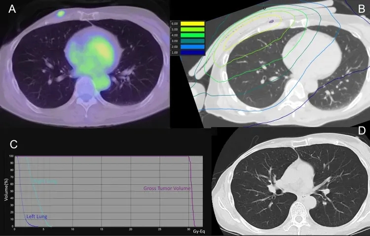 BNCT治疗乳腺癌的效果