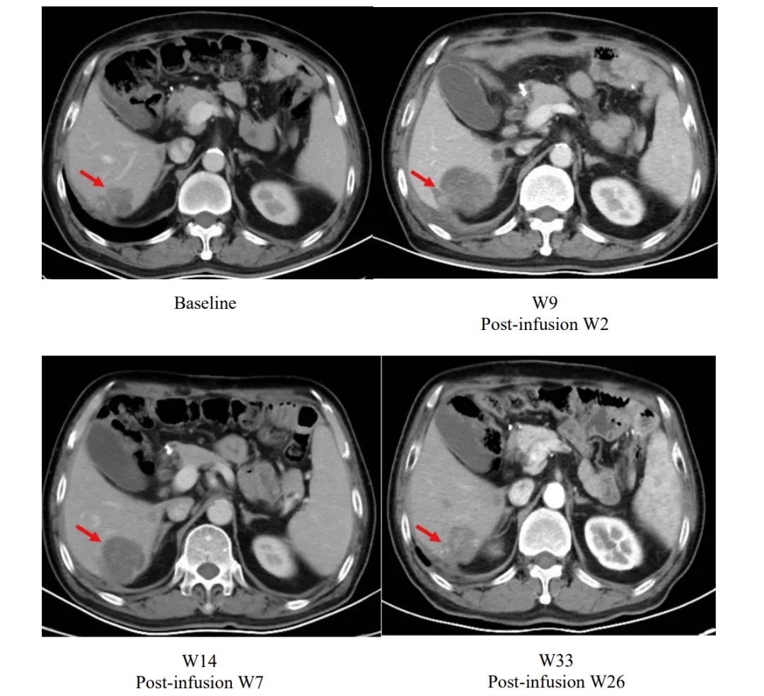 舒瑞基奥仑赛治疗效果 舒瑞基奥仑赛治疗效果