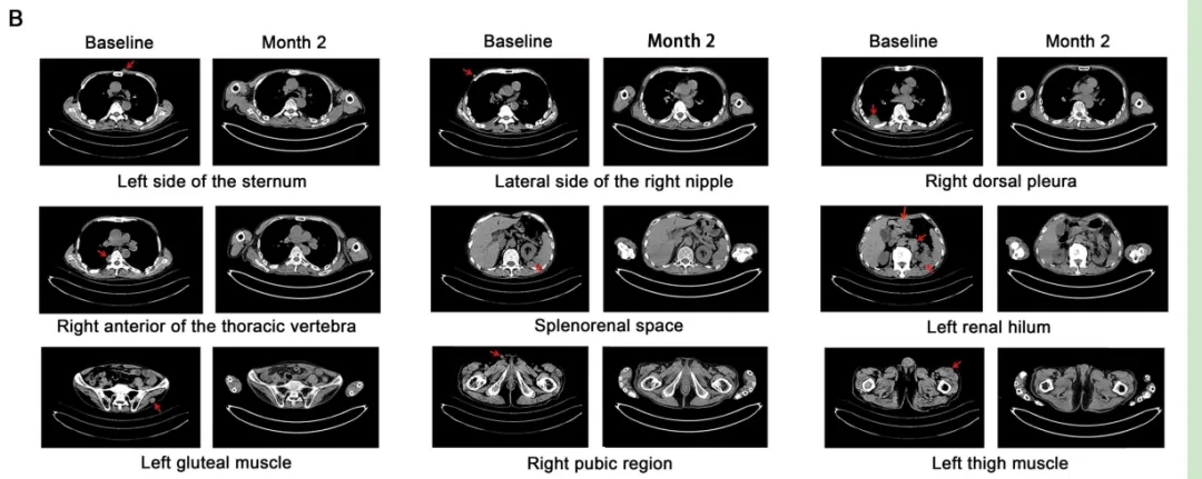 ESO-T01治疗效果 ESO-T01治疗效果