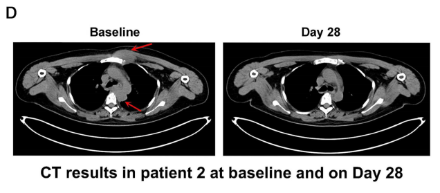 ESO-T01治疗效果 ESO-T01治疗效果