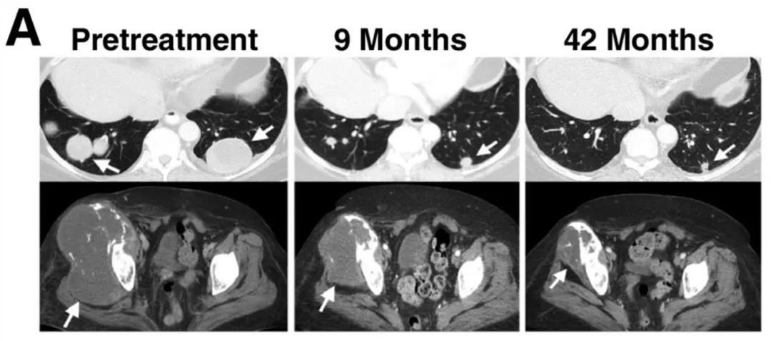 NY-ESO-1治疗效果 NY-ESO-1治疗效果