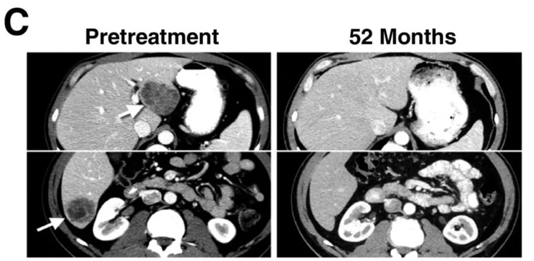 NY-ESO-1治疗黑色素瘤转移的效果 NY-ESO-1治疗黑色素瘤转移的效果