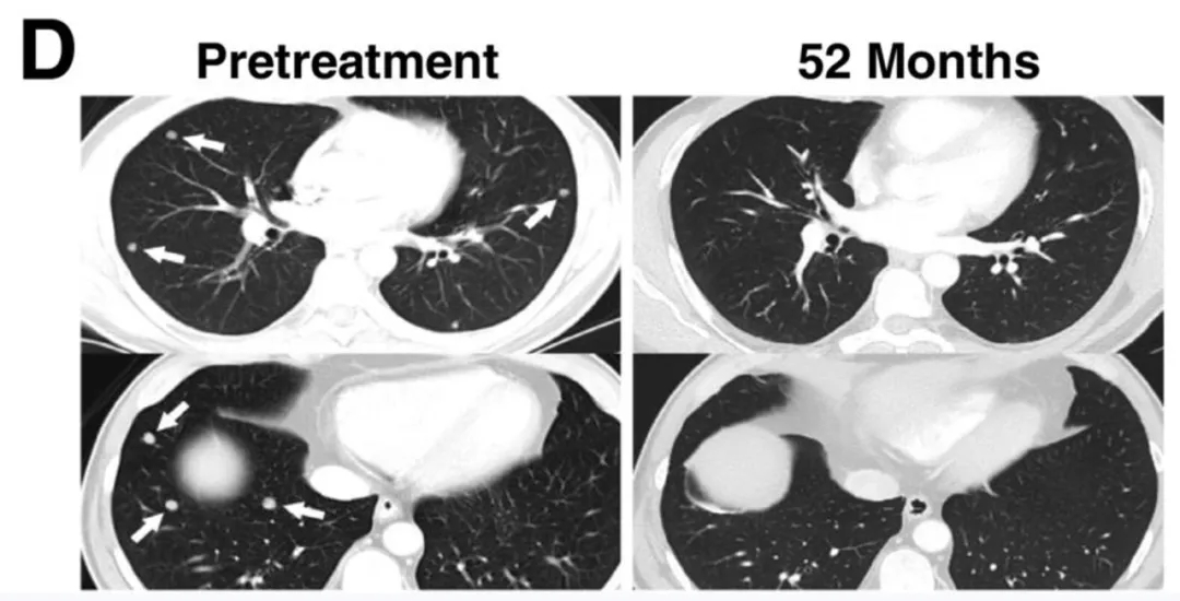 NY-ESO-1治疗黑色素瘤的效果 NY-ESO-1治疗黑色素瘤的效果