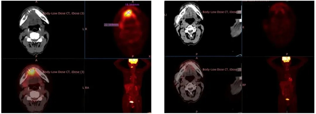 GT201治疗头颈鳞癌的效果 GT201治疗头颈鳞癌的效果
