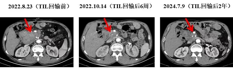 GC101治疗晚期胰腺癌的效果 GC101治疗晚期胰腺癌的效果