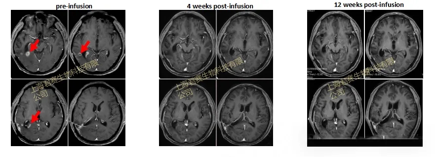 GC101治疗脑胶质瘤的效果 GC101治疗脑胶质瘤的效果