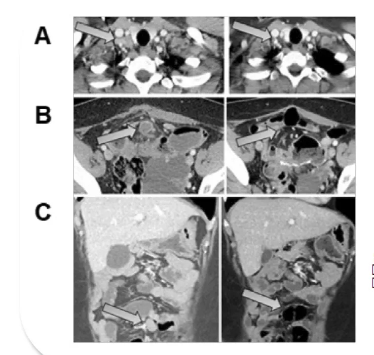 CRISPR-TIL治疗结直肠癌的效果 CRISPR-TIL治疗结直肠癌的效果