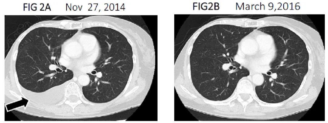 NK细胞疗法治疗乳腺癌的效果