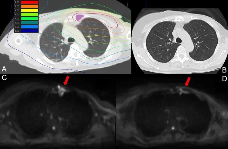 硼中子俘获疗法治疗乳腺癌的效果