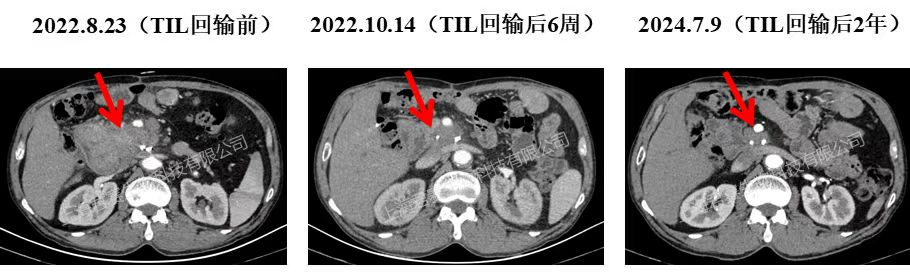 GC101治疗胰腺癌的效果 GC101治疗胰腺癌的效果