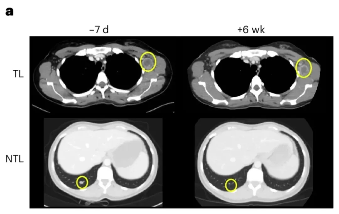BNT211治疗黑色素瘤的效果