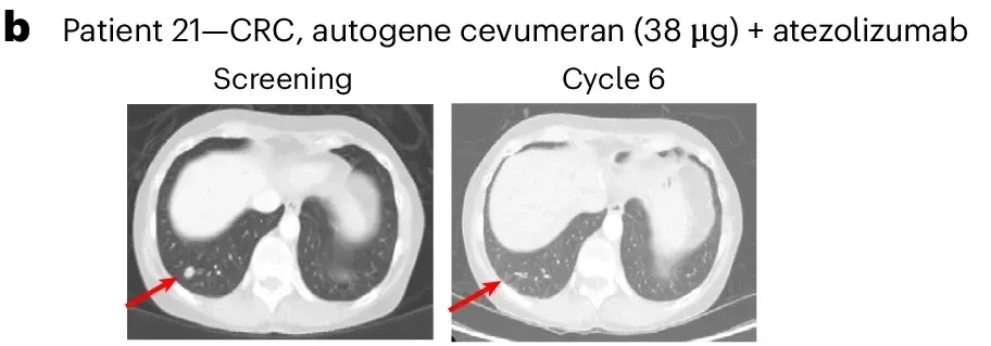 BNT211治疗直肠癌的效果